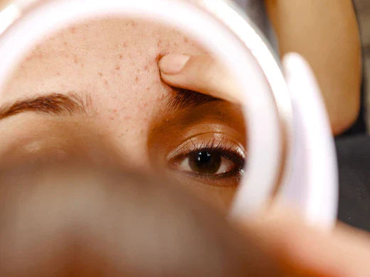 acne prone skin