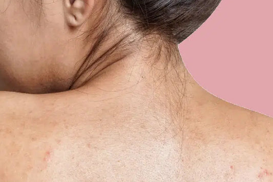 Back Acne “Bacne” Breakout? How to Treat & Prevent Back Pimples