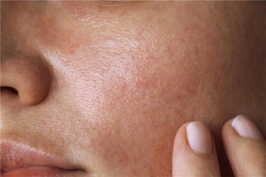 Can oily skin be dehydrated?
