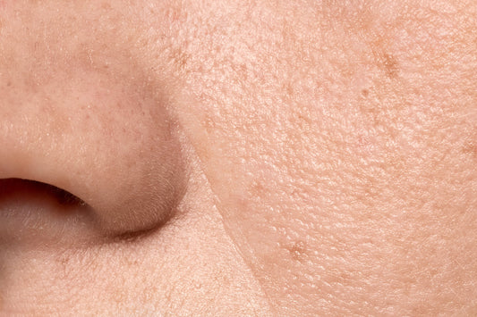 clogged pores: causes and treatments