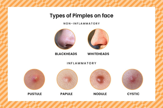 Types Of Acne & Pimples