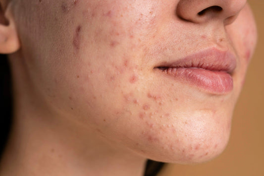 How Azelaic Acid and Niacinamide Together Can Fight Both Redness and Dark Spots
