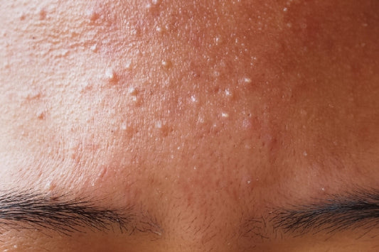 sweat induced breakouts