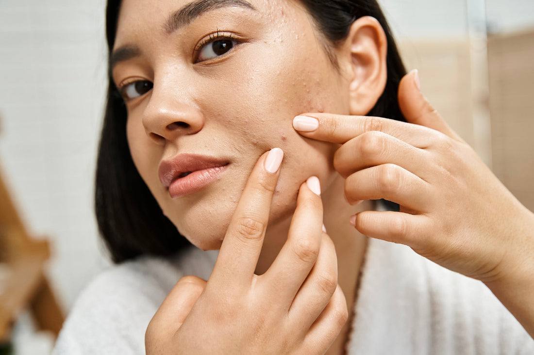 Controlling oil and acne in monsoon