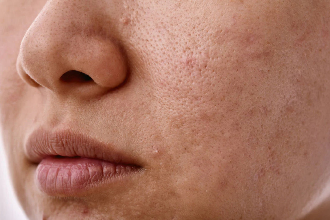 Niacinamide for sebum regulation