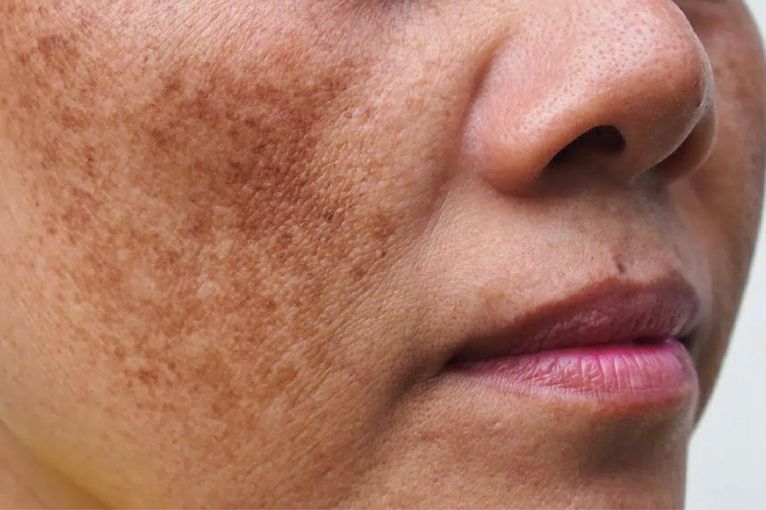 What is Post Inflammatory Hyperpigmentation: Causes, Prevention & Treatments