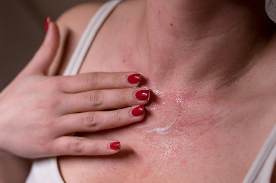 Stay Cool This Summer: Tips to Prevent and Treat Heat Rash