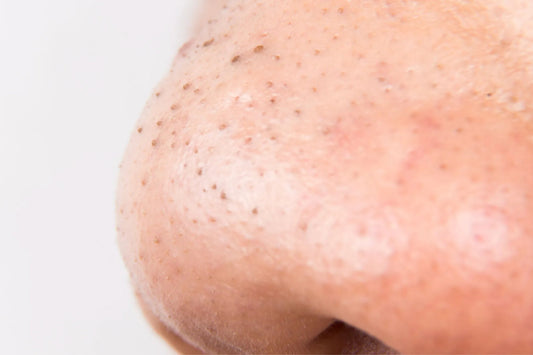 Blackheads - What Do They Look Like, Treatment And Prevention