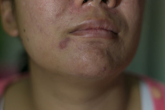 sensitive skin
