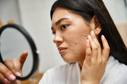 How To Care For Acne-Prone Skin?
